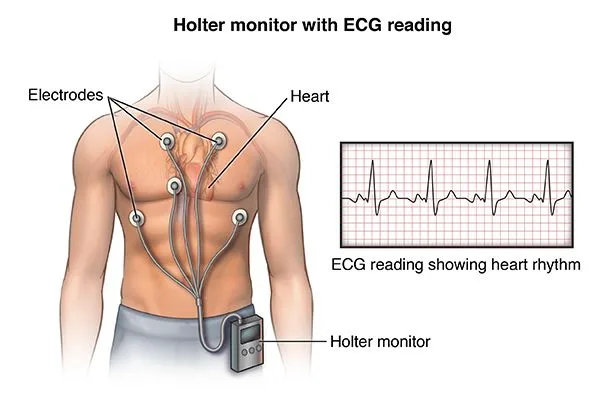 Holter Monitor